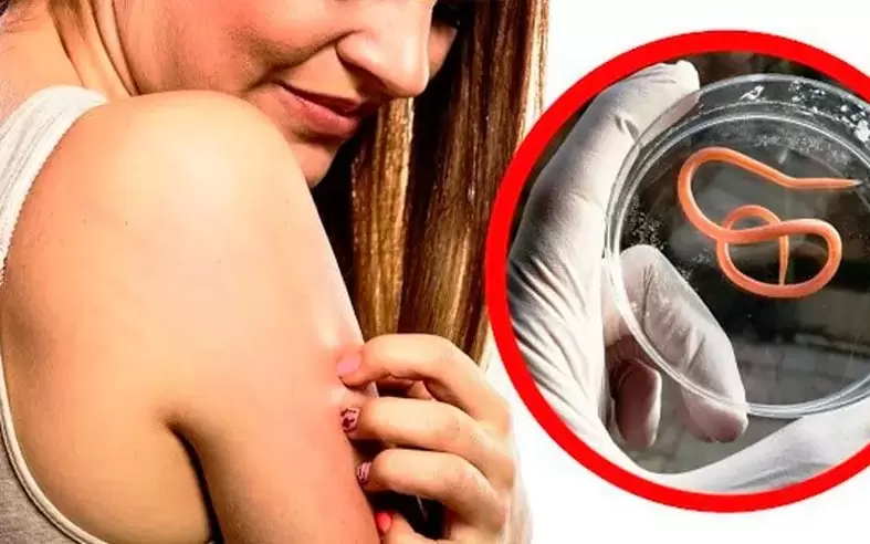 svrbenie a podráždenie spôsobené parazitmi v tele