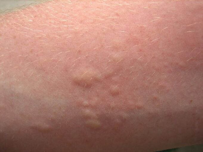 svrbivé alergické kožné vyrážky môžu byť príznakmi ascariázy