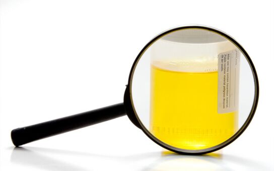 Vyšetrenie moču na diagnostiku schistosomiázy