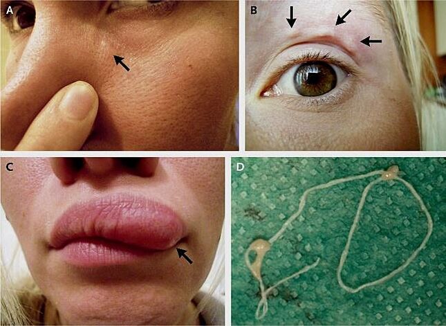 Hlavné prejavy dirofilariázy na tvári